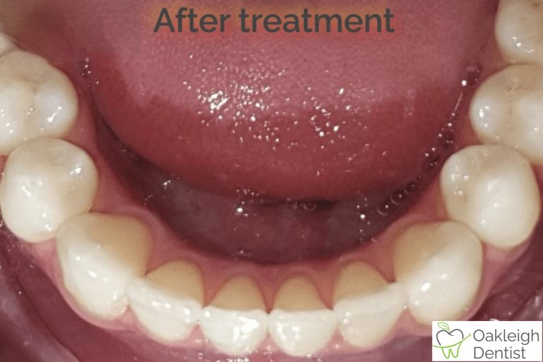 Invisalign 1 after